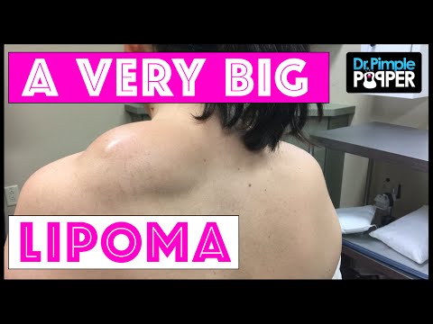 Excision of a Large Lipoma on the Shoulder using Tumescent Technique
