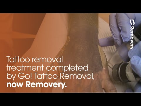 Laser Tattoo Removal On A Blacked Out Hand  | Go Tattoo Removal, Now Removery