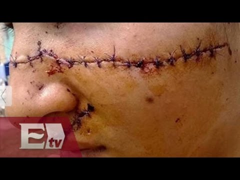 Desfiguran el rostro de una jovencita argentina por hermosa/ Global