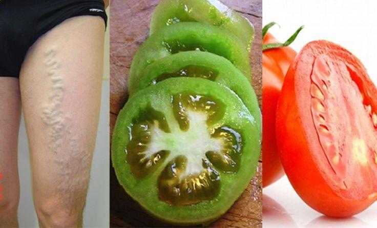 Como se livrar das varizes apenas com 2 tomates