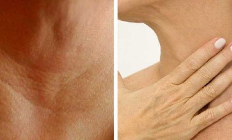 Tratamentos naturais para prevenir o surgimento de rugas no pescoço e nas mãos