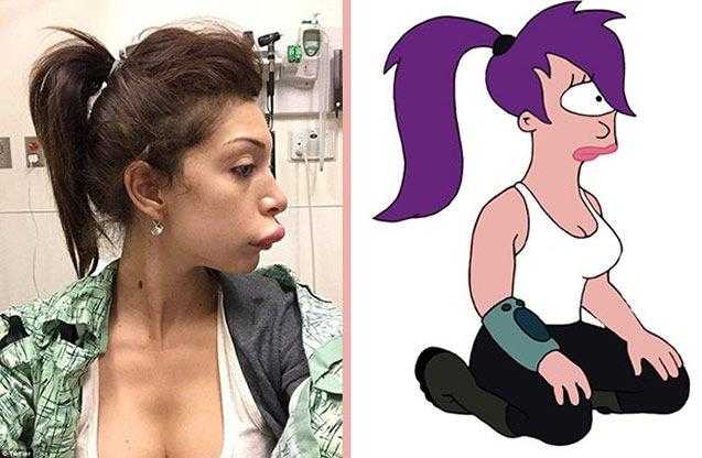 Atriz fez cirurgia para ter labios da Angelina Jolie, mas ficou a cara da Leela do Futurama!
