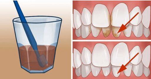 Este remédio vai te ajudar a se livrar de manchas feias de tártaro de seus dentes