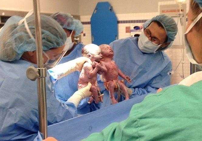 Veja como estão as gêmeas que nasceram de mãos dadas ha 2 anos