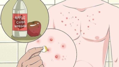 Remédios caseiros para eliminar a acne no peito, ombros e costas f