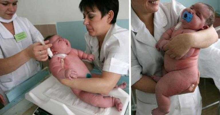 Bebê nasce com 18 kg e bate o recorde de maior bebê do mundo 05