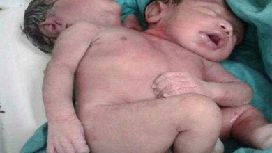 Grávida acreditava esperar gêmeos, mas bebê nasce com duas cabeças