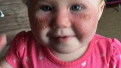 Bebê sofre queimadura de 2º grau em sua face por algo toda a gente utiliza no verão!