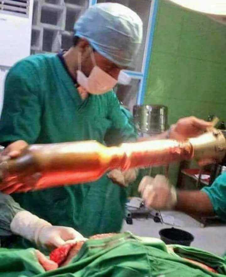 Médicos retiram míssil que estava preso nas nádegas de paciente