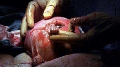 Feto agarra médico de dentro do útero, com apenas 21 semanas. 16 anos depois, isso foi o que aconteceu com o bebê.