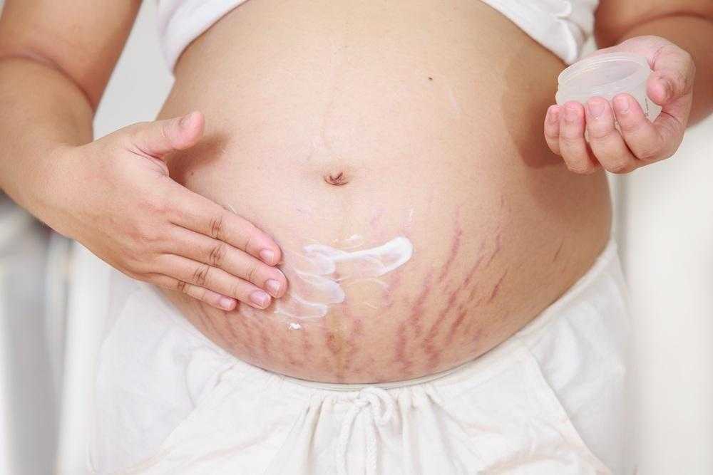 Como tratar as estrias da barriga após a gravidez 5
