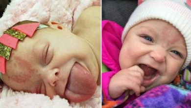 Bebê que nasceu com língua gigante sorri pela 1ª vez após cirurgia Q