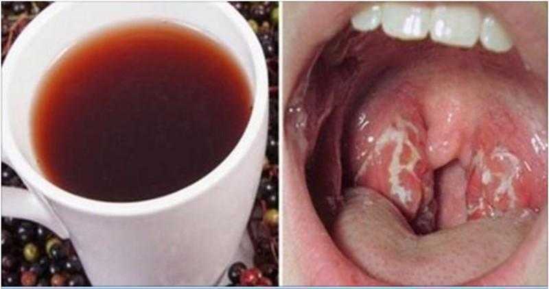 Como se livrar de uma infecção de garganta de forma natural e em pouco tempo