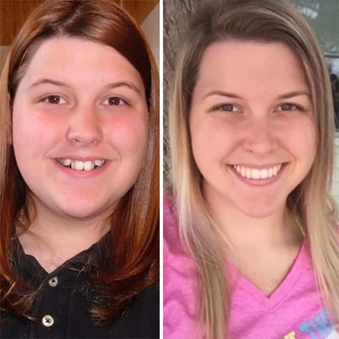 20 transformações quase inacreditáveis de pessoas que tinham dentes fora do lugar