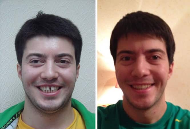 20 transformações quase inacreditáveis de pessoas que tinham dentes fora do lugar