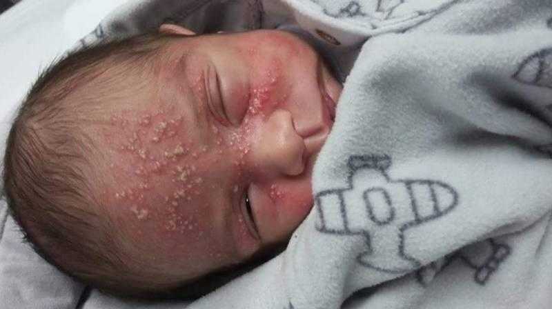Bebê de 17 dias contrai herpes após beijo de visita