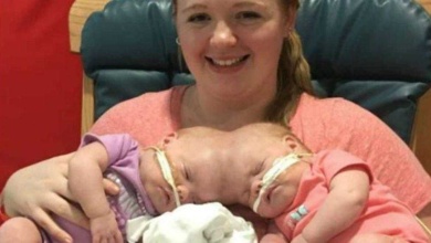 Bebês que nasceram unidas pela cabeça são separadas! Veja elas hoje:
