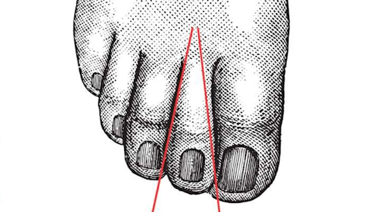 Base estreita no segundo dedo do pé