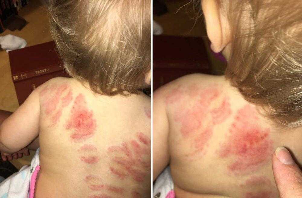 Mãe denuncia creche após filha de 1 ano receber mais de 25 mordidas nas costas