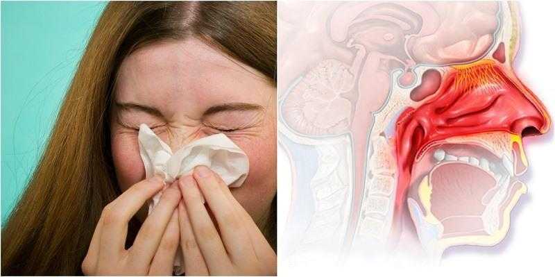 4 remédios caseiros para ajudar a curar o nariz entupido