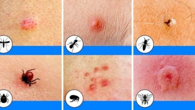 10 tipos de picadas de insetos que você deve reconhecer