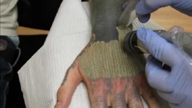 Incrível: médico grava retirada com laser de uma tatuagem gigante