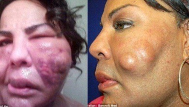 Mulher transgênero injetou cimento no rosto.