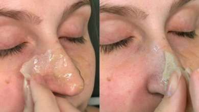 elimine cravos do seu rosto em apenas 15 minutos
