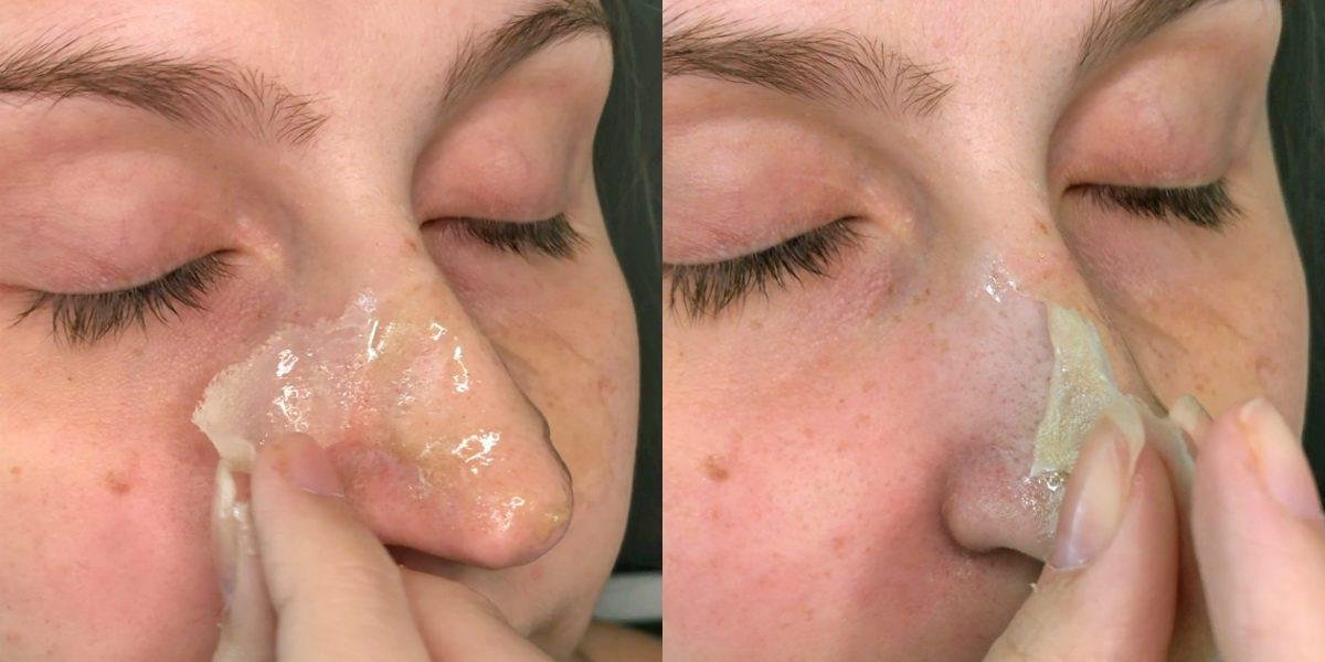 elimine cravos do seu rosto em apenas 15 minutos