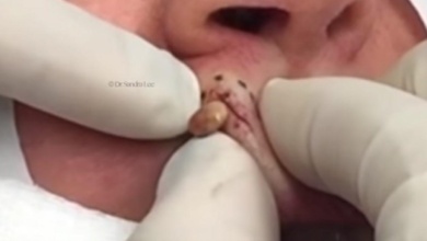 vídeo surpreende ao mostrar cravo gigante parecido com carrapato sendo retirado do rosto de uma mulher