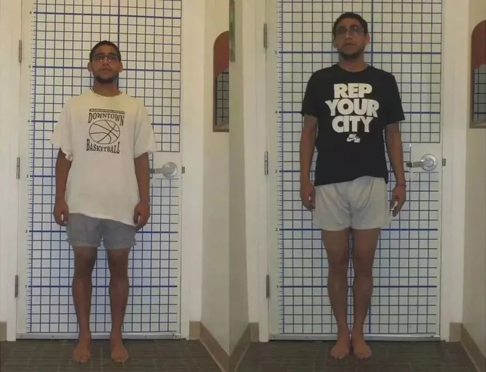 sam passou por uma cirurgia que o ajudou a ganhar alguns centimetros