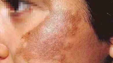 Livre-se das manchas pretas do seu rosto, agora com essa receita caseira