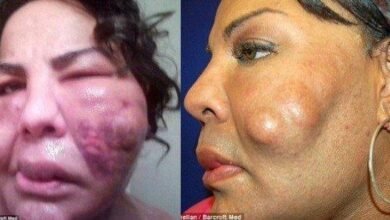 Mulher transgênero injetou cimento no rosto. Veja os acontecimentos 10 anos depois…