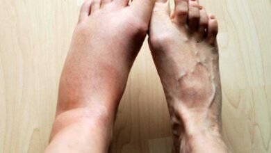 4 Sinais nos seus pés podem indicar se você corre o risco de um infarto ou AVC. Saiba identificar