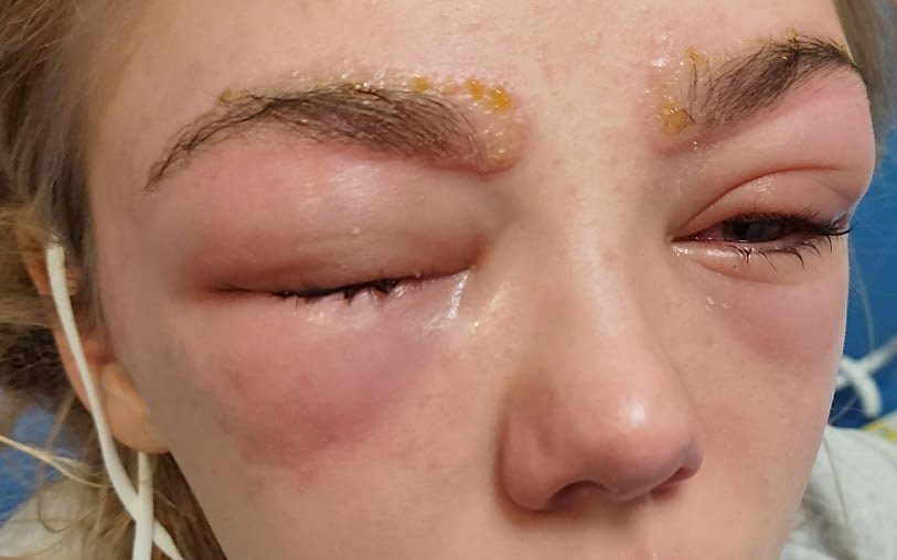 'i was screaming in pain': girl, 14, 'almost loses eyesight' after severe allergic reaction to eyebrow treatment