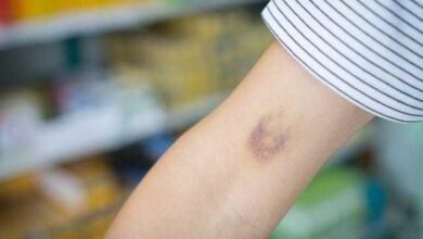 Hematomas sem motivo aparente pode ser sinal de alguma dessas doenças