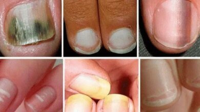 Suas unhas se encontram com algum destes aspectos? CUIDADO para o que pode significar