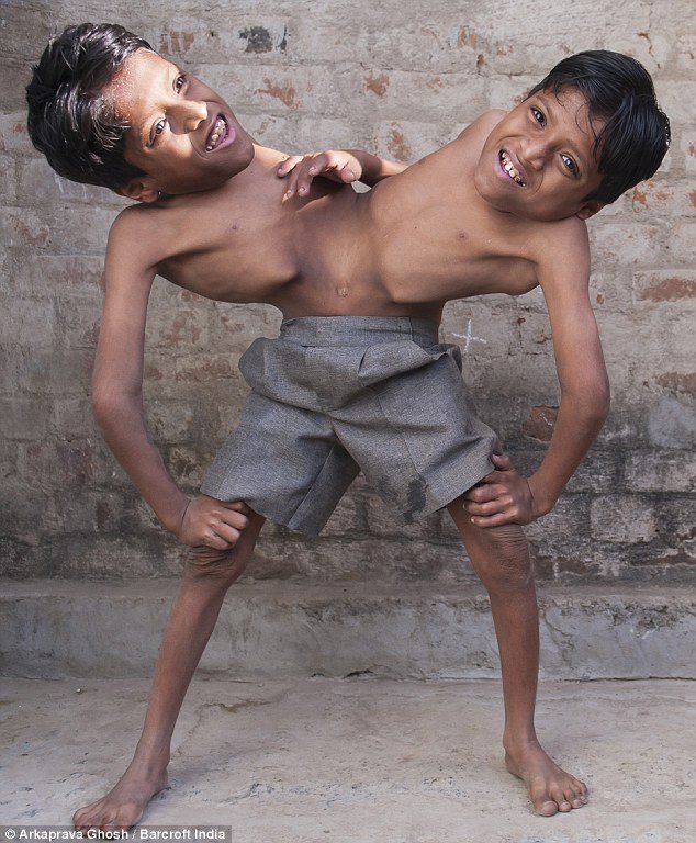 Gêmeos siameses de 12 anos Gêmeos siameses de 12 anos