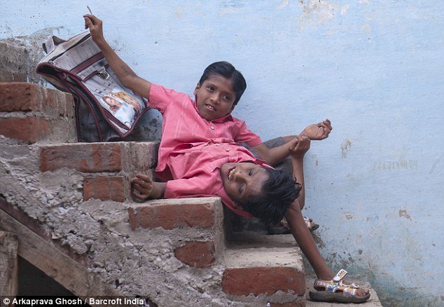 Gêmeos siameses de 12 anos