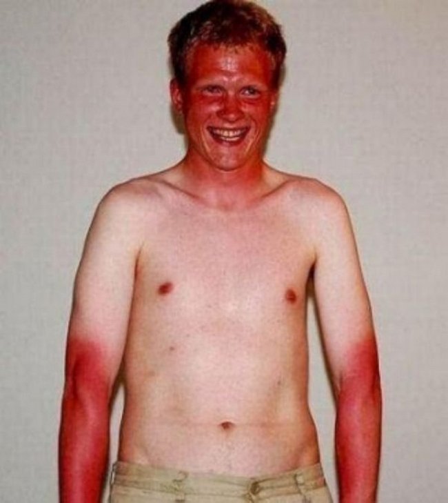 6-18-pessoas-que-esqueceram-o-quanto-as-marcas-de-sol-podem-ser-constrangedoras-as-vezes