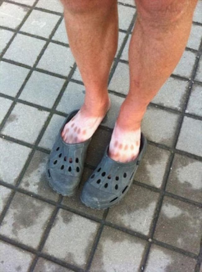 8-18-pessoas-que-esqueceram-o-quanto-as-marcas-de-sol-podem-ser-constrangedoras-as-vezes