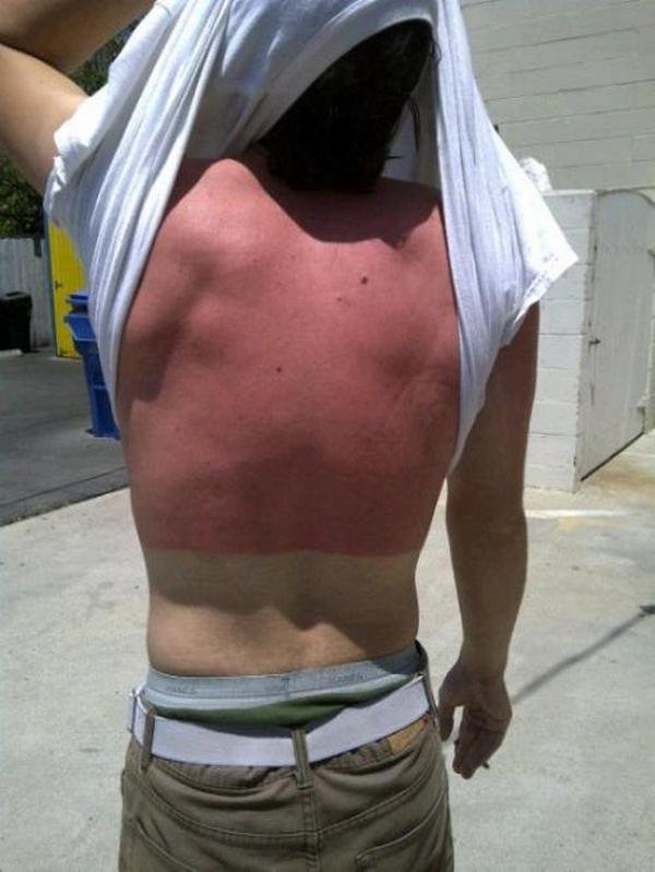 17 Pessoas que esqueceram o quanto as marcas de sol podem ser constrangedoras 