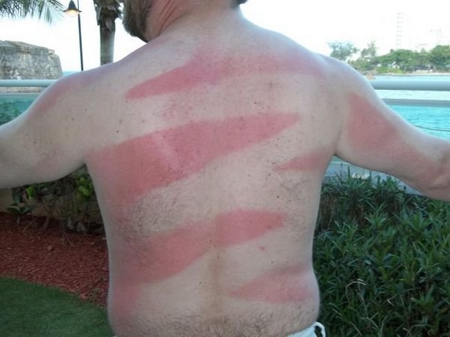 12-18-pessoas-que-esqueceram-o-quanto-as-marcas-de-sol-podem-ser-constrangedoras-as-vezes