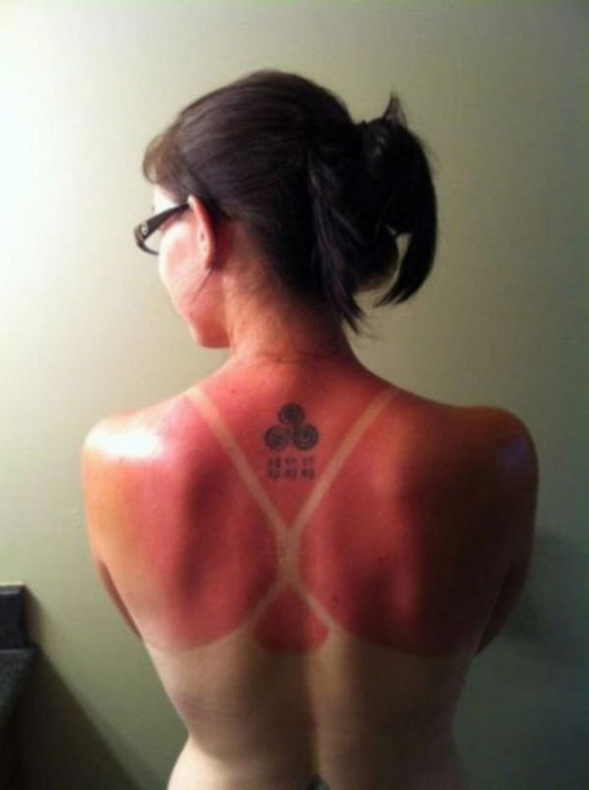 15-18-pessoas-que-esqueceram-o-quanto-as-marcas-de-sol-podem-ser-constrangedoras-as-vezes