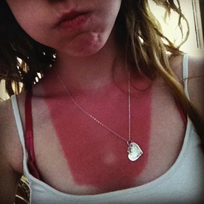 17-18-pessoas-que-esqueceram-o-quanto-as-marcas-de-sol-podem-ser-constrangedoras-as-vezes