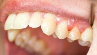 Remédios caseiros para a inflamação das gengivas