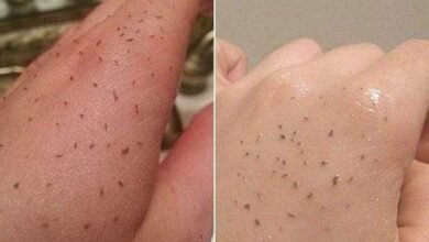 Truque simples para remover cravos com pasta de dente