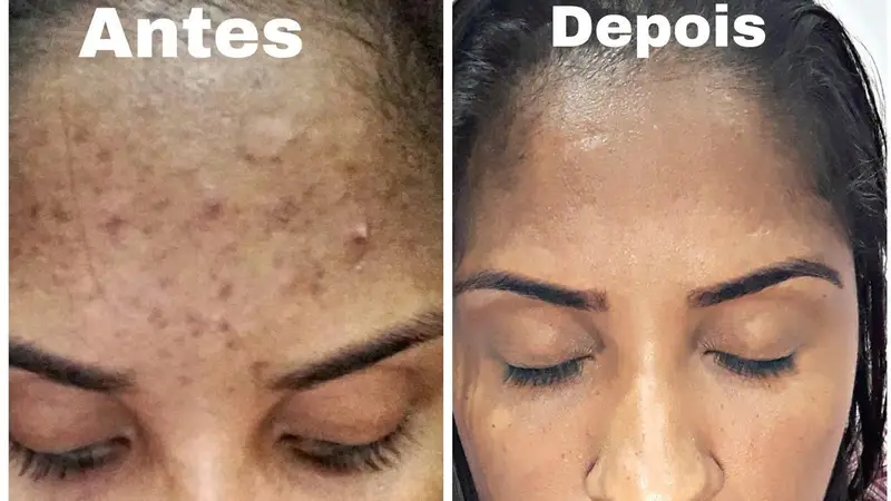 5 Mascaras caseiras para remover manchas e cicatrizes do rosto