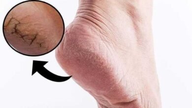 Creme caseiro para hidratar e afinar os pés