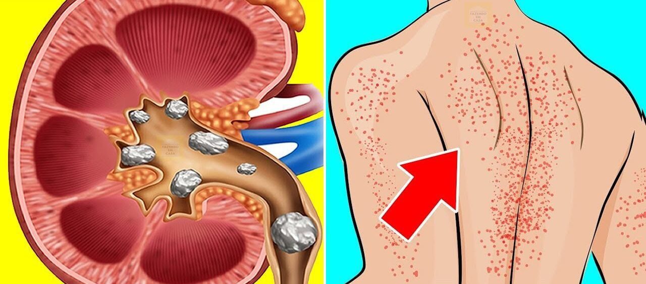 8 Sinais de que os rins não estão funcionando bem que muita gente desconhece